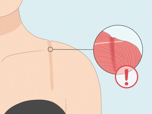 An image showing red marks or chafing on a person's shoulder from a poorly fitting bra strap.
